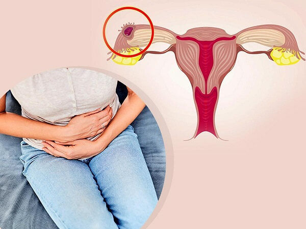 Mang thai ngoài tử cung là gì?