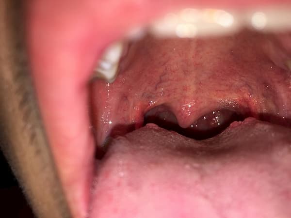 Bệnh sùi mào gà ở lưỡi nguyên nhân triệu chứng và cách điều trị