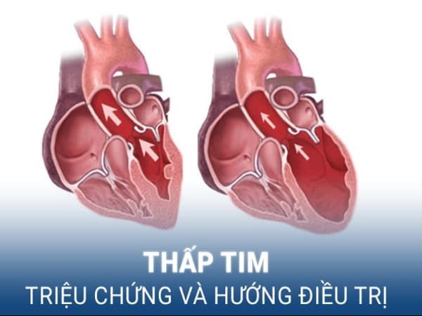 Bệnh thấp tim là gì?