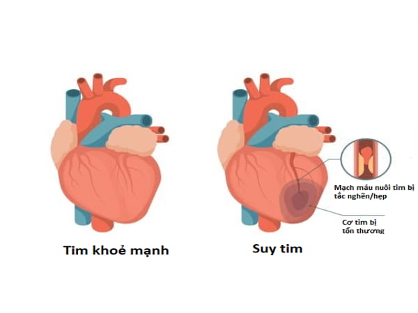 Dấu hiệu của suy tim nhận biết sớm để phòng ngừa