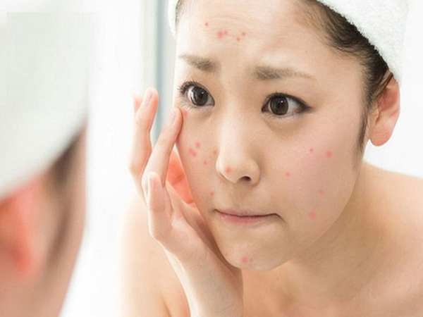 Nguyên nhân gây mụn ở tuổi dậy thì