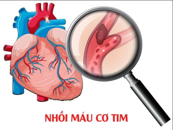 Tìm hiểu về nhồi máu cơ tim