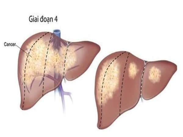 Giai đoạn 4: Di căn ra xa (giai đoạn cuối)