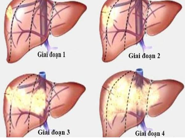 Ung thư gan có mấy giai đoạn