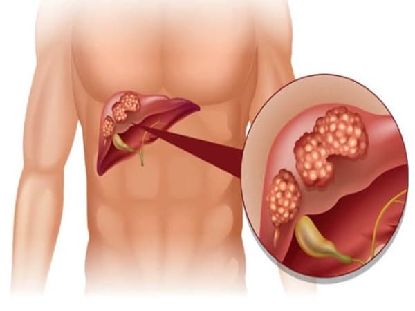 Ung thư gan có chữa được không