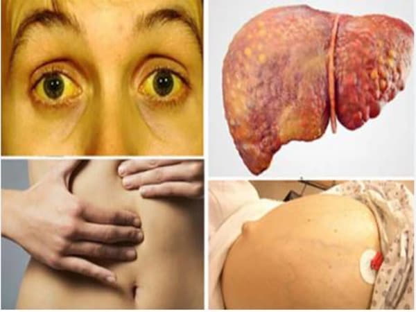 Cần làm gì khi nhận thấy những dấu hiệu ưng thư gan giai đoạn cuối
