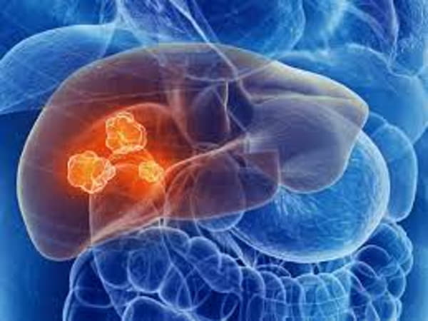 Chức năng gan suy giảm không lọc được chất độc