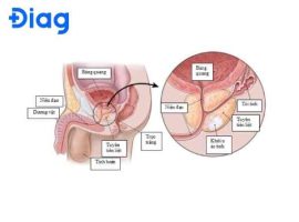 dấu hiệu ung thư tuyến tiền liệt